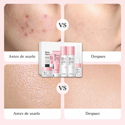 💖 Kit Rose Hyaluronic Acid 6 en 1 + Envío Gratis 🎁 El Regalo Perfecto